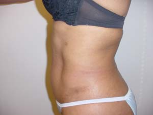 After Lipo procedure by Dr. Ralph Massey in Los Angeles